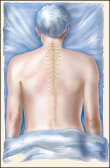 Cervical Foraminotomy - Jeffrey M. Spivak M.D. Orthopaedic Spine Surgeon