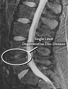 Degenerative Disc Disease - Jeffrey M. Spivak M.D. Orthopaedic Spine Surgeon