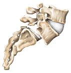 Spondylolisthesis - Jeffrey M. Spivak M.D. Orthopaedic Spine Surgeon