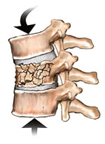 Vertebral Compression Fractures - Jeffrey M. Spivak M.D. Orthopaedic Spine Surgeon