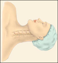 Anterior Cervical Discectomy with Fusion - Jeffrey M. Spivak M.D. Orthopaedic Spine Surgeon
