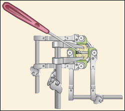 Anterior Cervical Discectomy w/ Fusion