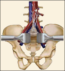 ALIF - Jeffrey M. Spivak M.D. Orthopaedic Spine Surgeon