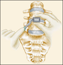 Anterior Lumbar Interbody Fusion - Jeffrey M. Spivak M.D. Orthopaedic Spine Surgeon