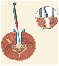 Cervical Disc Arthroplasty