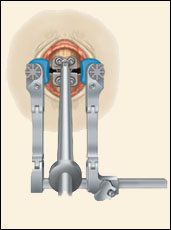 Cervical Disc Arthroplasty