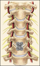 Cervical Disc Surgery