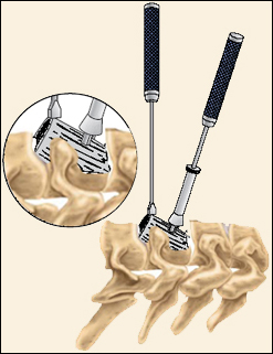 Cervical Corpectomy - Jeffrey M. Spivak M.D. Orthopaedic Spine Surgeon