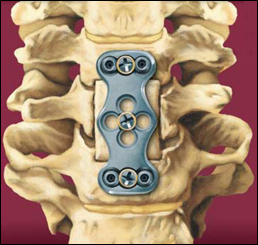 Cervical Corpectomy