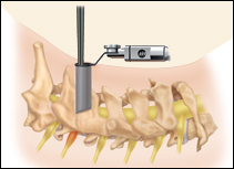 Cervical Foraminotomy - Jeffrey M. Spivak M.D. Orthopaedic Spine Surgeon