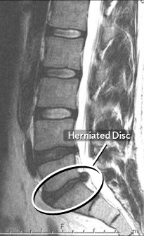 Herniated Discs - Jeffrey M. Spivak M.D. Orthopaedic Spine Surgeon