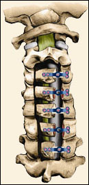 Cervical Laminoplasty - Jeffrey M. Spivak M.D. Orthopaedic Spine Surgeon