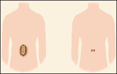 Transforaminal Lumbar Interbody Fusion (TLIF)