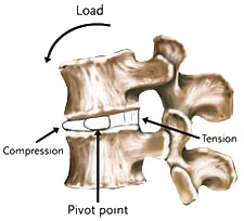 DDD - Jeffrey M. Spivak M.D. Orthopaedic Spine Surgeon