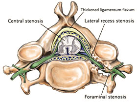 Stenosis Surgery - Jeffrey M. Spivak M.D. Orthopaedic Spine Surgeon
