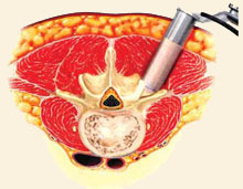 Transforaminal Lumbar Interbody Fusion (TLIF)