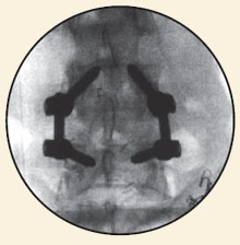 Transforaminal Lumbar Interbody Fusion (TLIF)