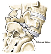 Spondylolisthesis Surgery - Jeffrey M. Spivak M.D. Orthopaedic Spine Surgeon