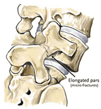 Spondylolisthesis type II B - Jeffrey M. Spivak M.D. Orthopaedic Spine Surgeon