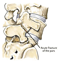 Spondylolisthesis Type II C - Jeffrey M. Spivak M.D. Orthopaedic Spine Surgeon