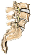 Spondylolisthesis Type III - Jeffrey M. Spivak M.D. Orthopaedic Spine Surgeon