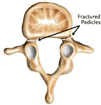 Spondylolisthesis Type IV - Jeffrey M. Spivak M.D. Orthopaedic Spine Surgeon