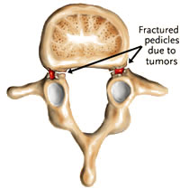 Spondylolisthesis Type V - Jeffrey M. Spivak M.D. Orthopaedic Spine Surgeon